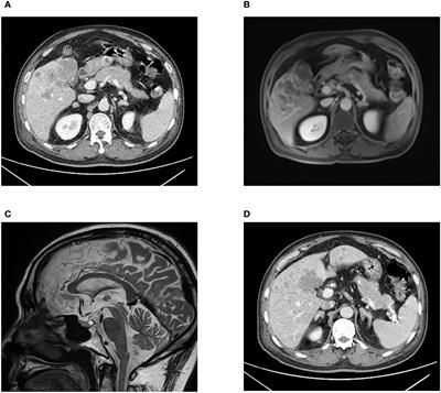 ACTH-producing small cell neuroendocrine carcinoma from the gallbladder: a case report and literature review